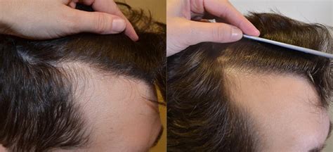 Finasteride Treatment For Hairline Restoration And Maintenance Hair