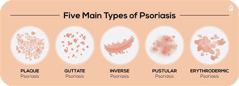 5-Main-Types-of-Psoriasis-The-Dermatology-Specialists - Theayurveda