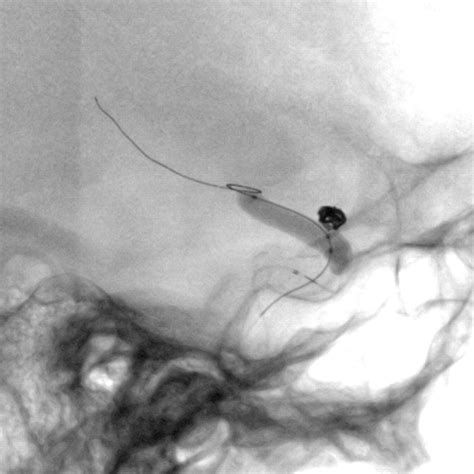 Endovascular Treatment Of Unruptured Intracranial Aneurysms Comparison