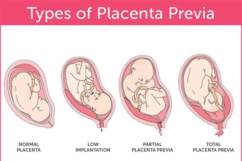 My Family Medicine Practice: Placenta Previa - A Low Lying Placenta