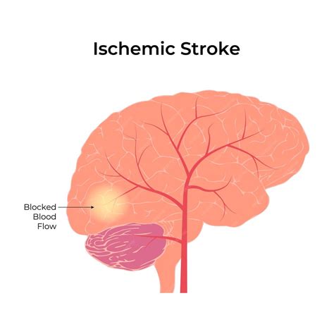 premium vector ischemic stroke blocked blood flow vector illustration