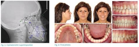 Case Presentation Non Surgical Correction Of Class Iii By Dr John Pobanz Orthotown