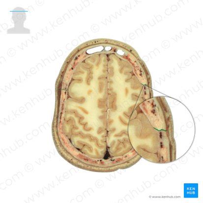 Coronal suture: Anatomy and function | Kenhub