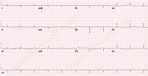 Electrical Alternans Ecg Example Learntheheart