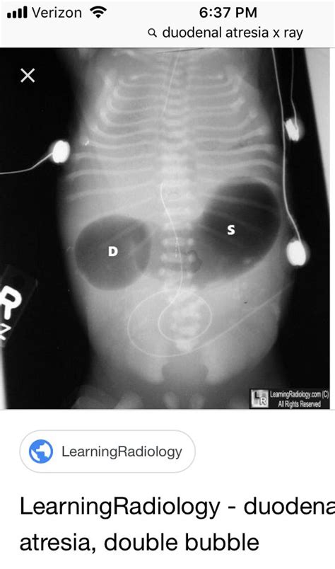 Duodenal Atresia X Ray