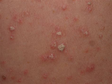 Guttate Psoriasis StatPearls NCBI Bookshelf