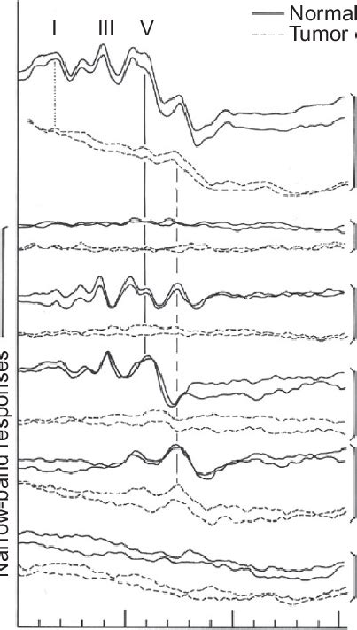 6 Wide Band And Narrow Band Auditory Brainstem Responses Abrs For Download Scientific