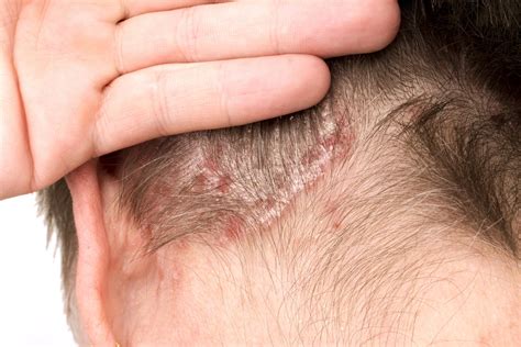 Everything You Need To Know About Seborrheic Dermatitis — Kapyderm Usa