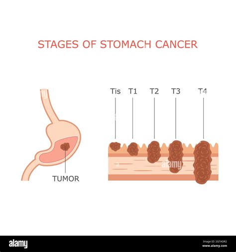 Stades Du Cancer De L Estomac Anatomie De La Tumeur Gastrique Humaine