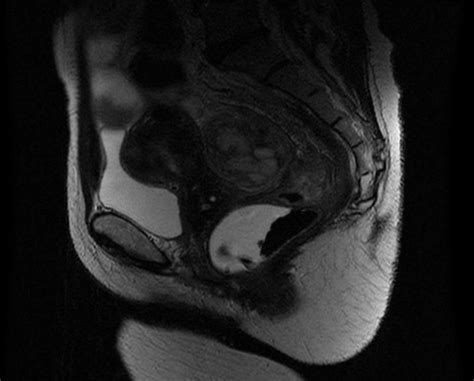 Sagital T Weighted Pelvic Magnetic Resonance Image Depicting The Same