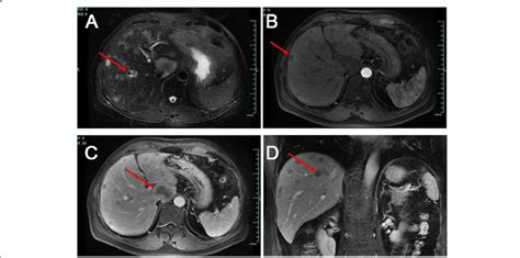 Mri Scan Images Of A Hepatic Epithelioid Hemangioendothelioma Patient