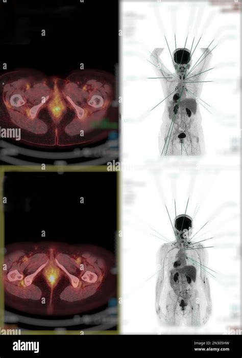 Positron emission tomography (PET) CT scan uses a radioactive drug ...