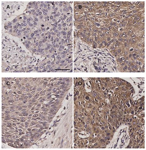 Expression Of Integrin And Hax Correlates With Aggressive Fe Cmar