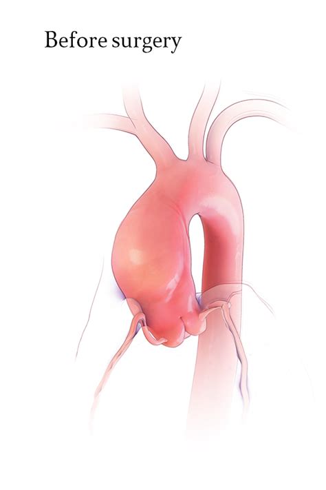 Emory Aortic Center | Patient Education