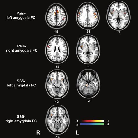 Correlation Between Amygdala Rsfc And Clinical Indices In Patients With