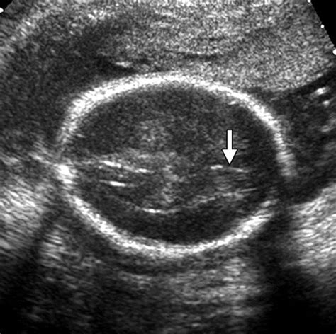 Holoprosencephaly Ultrasound