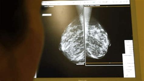 Breast Reconstruction Wait Times Deterring Women From Surgery British