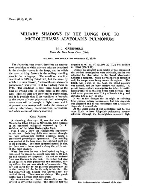 Miliary Shadows In The Lungs Due To Microlithiasis Alveolaris Pulmonum