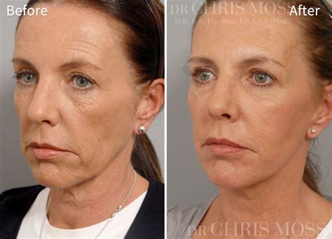 Facelift Surgery In Melbourne By Dr Chris Moss Including Smas