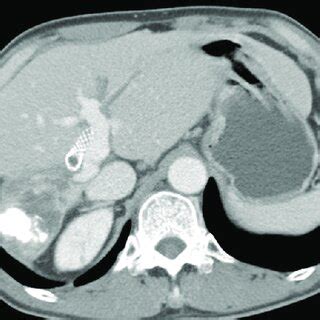 Follow Up Cholangiogram Obtained Days After Placement Of The Covered