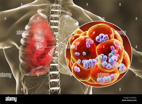 La Neumon A Neumoc Cica Ilustraci N Del Equipo De Streptococcus