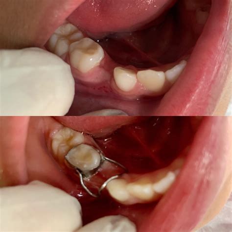 Aparelhos Mantenedores De EspaÇo Lourenço Odontologia