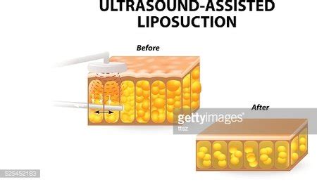 Ultrasound Assisted Liposuction Stock Vector Royalty Free FreeImages