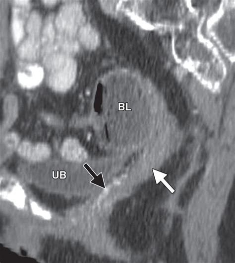 Pelvic Reconstruction With Omental And Vram Flaps Anatomy Surgical