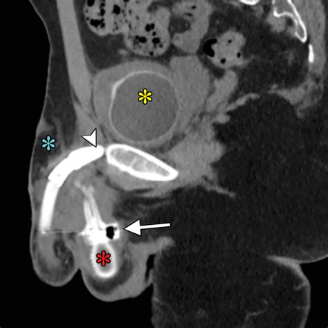 Imaging Findings In Transgender Patients After Gender Affirming Surgery