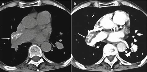 Embolism Radiology Key