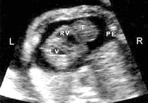 Prenatal Echocardiographic Differential Diagnosis Of Fetal Cardiac