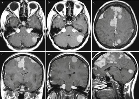 Meningioma Radiology Key