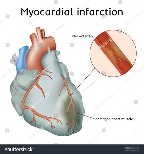 Myocardial Infarction Heart Attack Blocked Artery Stock Vector Royalty