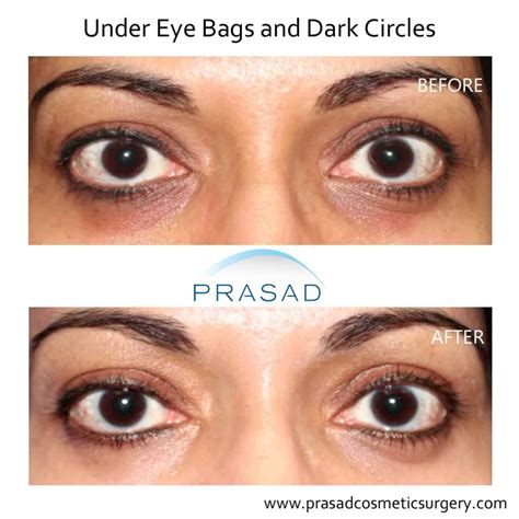 Treating Concurrent Under Eye Puffiness And Hollowness Prasad