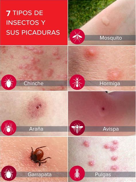 Las Picaduras De Insectos M S Comunes En Verano Y C Mo Prevenirlas