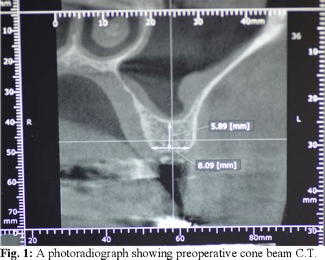 Figure 1 From EVALUATION OF COMBINATION OF BIPHASIC CALCIUM PHOSPHATE