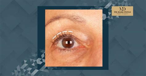 Upper Blepharoplasty Scars