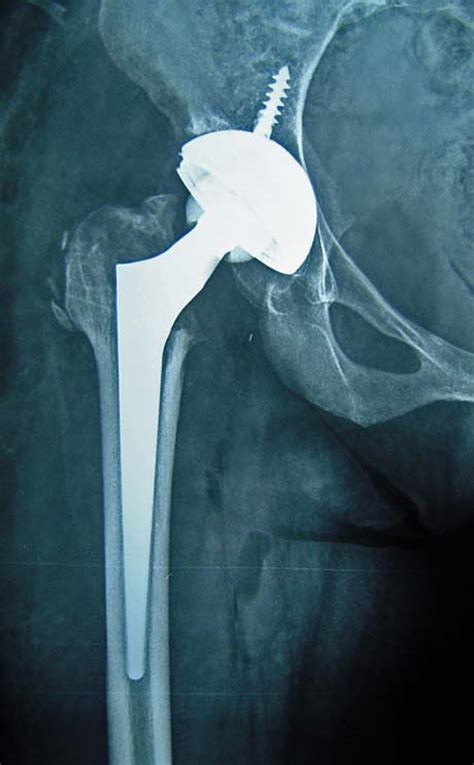 Congenital Hip Dysplasia Ddh George D Goudelis Md Ph D