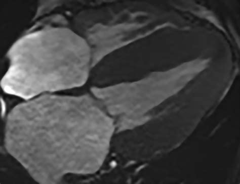 Radiological Detection of Cardiac Amyloid: MRI with Pathological ...