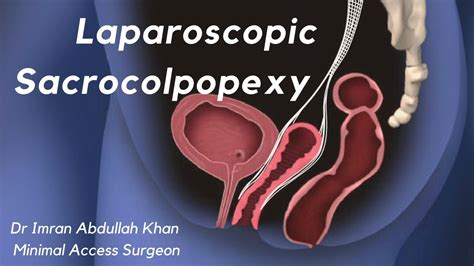 Laparoscopic Sacrocolpopexy For Vaginal Vault Prolapse Dr Imran