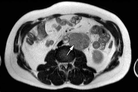 Testicular Seminoma And Its Mimics From The Radiologic Pathology