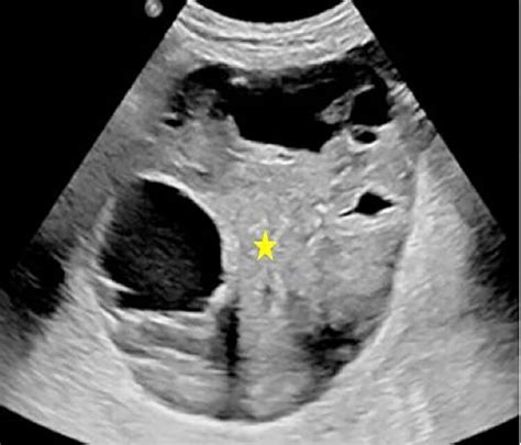 Pelvic Ultrasound Reveals A Large Well Defined And Heterogeneous Mass Download Scientific