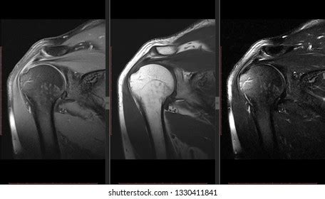 Shoulder Mri Scan Royalty-Free Images, Stock Photos & Pictures ...