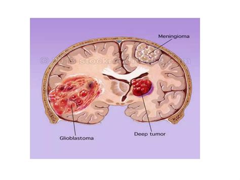 Intracranial Space Occupying Lesions Ppt