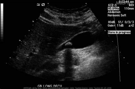 Cholelithiasis Ultrasound