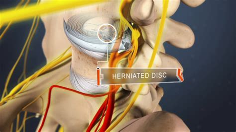 Lumbar Degenerative Disc Disease Treatment | Spine-health