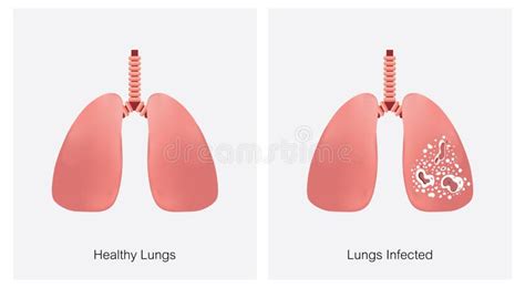 Tuberculosis Lungs Vs Healthy Lungs