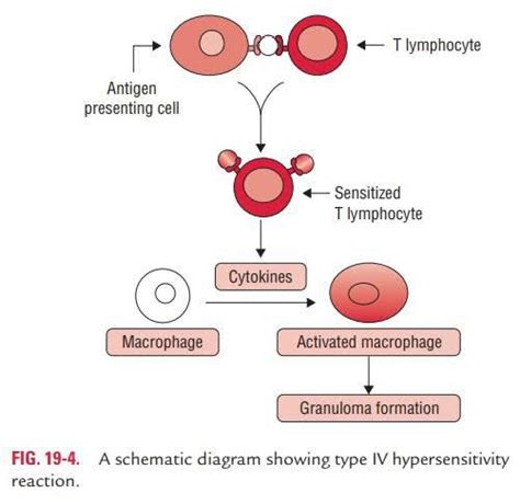 Delayed Hypersensitivity Medizzy