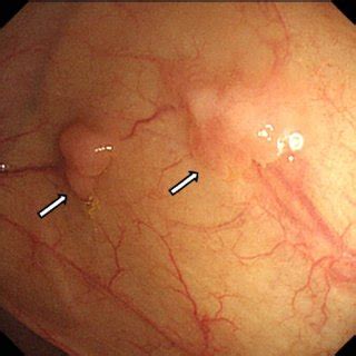 (PDF) Colonic High-grade Tubular Adenomas Associated with Schistosoma ...