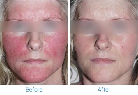 Before And After Laser Ipl Photofacial Jupiter